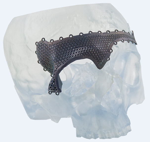 A 3D-Printed Craniomaxillofacial Implant and Model of Facial Reconstruction Surgery